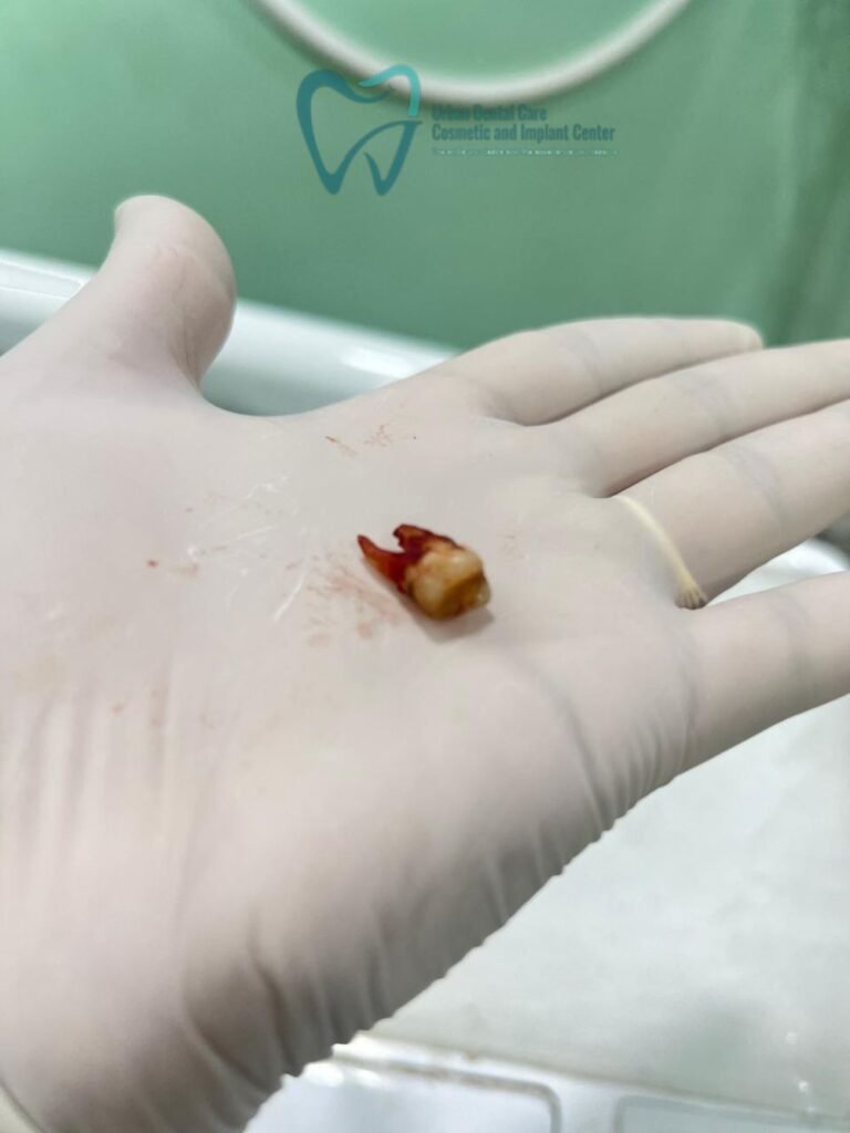 Best Tooth Extraction Treatment in Indirapuram