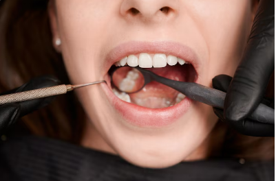 Best Tooth Extraction Treatment in Indirapuram