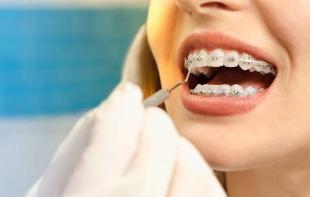 Closeup dental braces checkup , perfect white teeth with dental braces woman in half smile