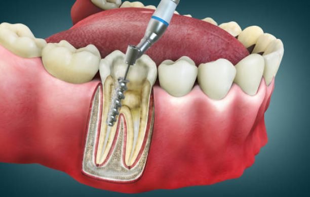 4D Root Canal Image