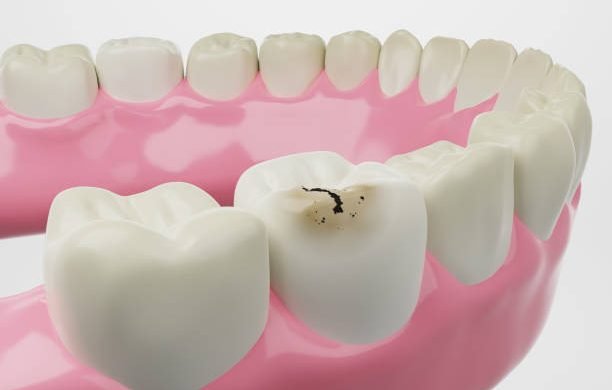 Tooth decay isolated white background 3D rendering.